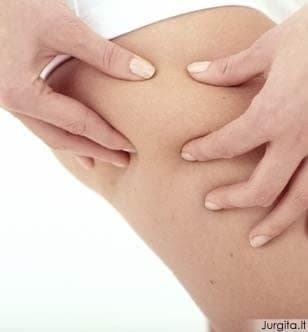 Cellulite: what it is, why you have it and what really helps